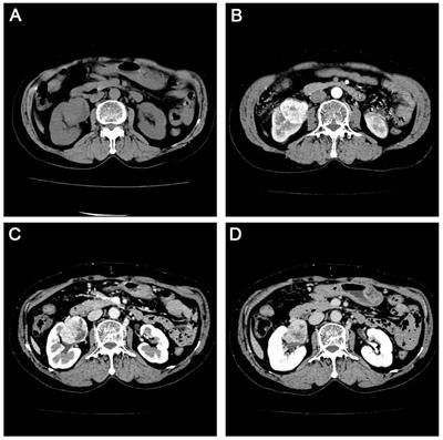 Whole-Exome Sequencing Reveals New Potential Mutations Genes for Primary Mucosa-Associated Lymphoid Tissue Lymphoma Arising From the Kidney